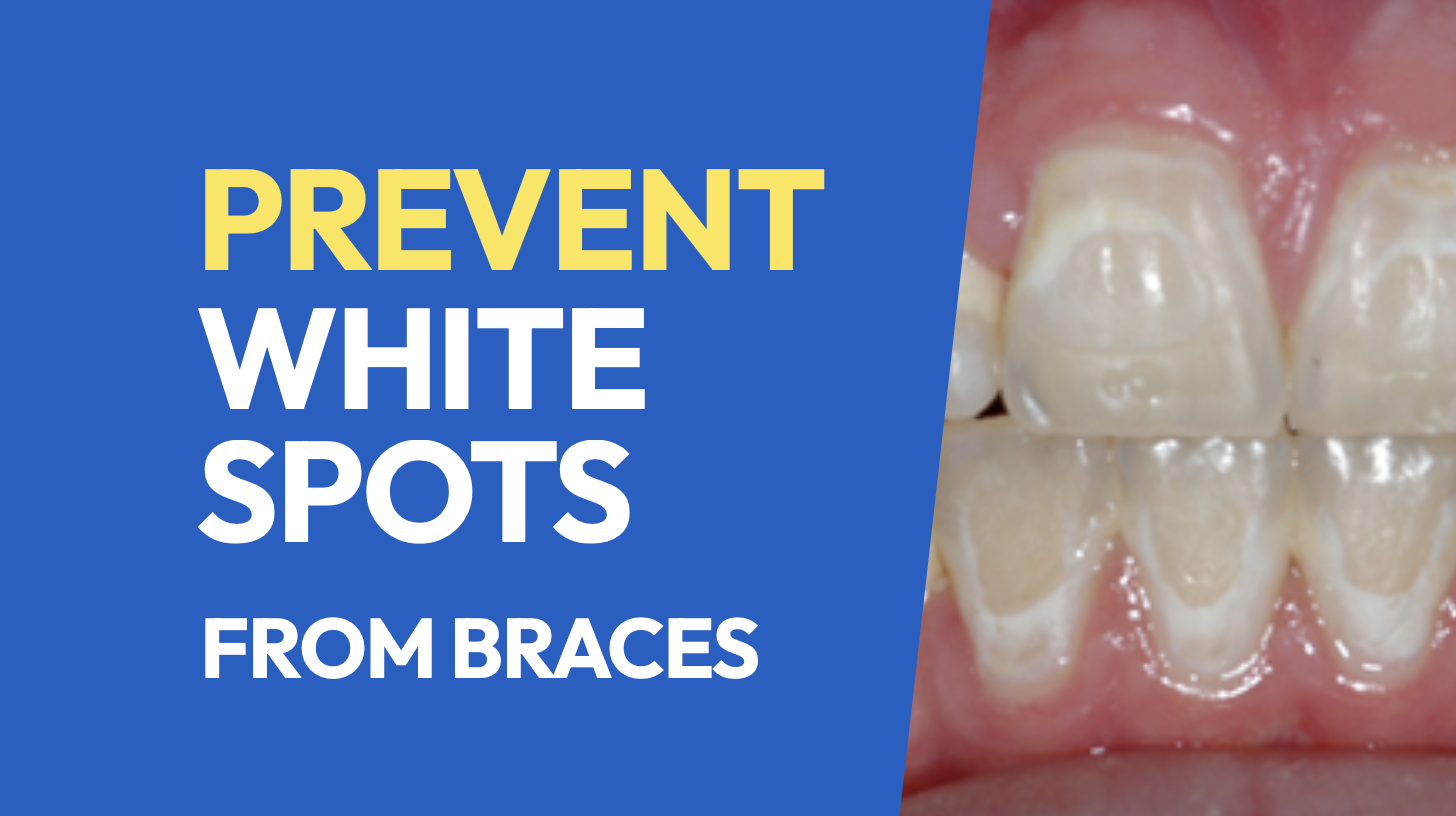 How to Prevent White Spots from Braces