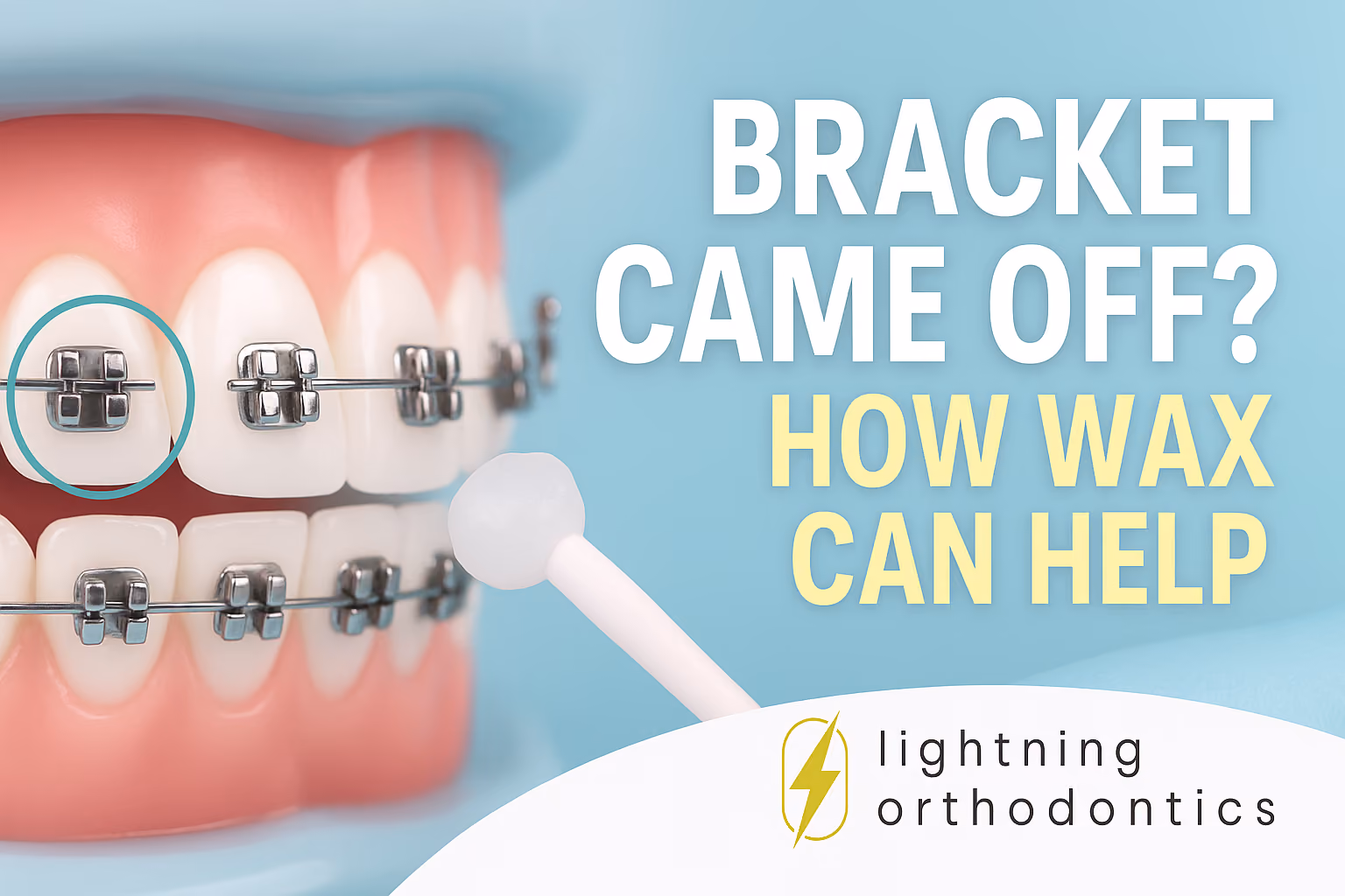 Bracket Came Off? Don’t Panic, Here’s How Wax Can Help Until You See Us