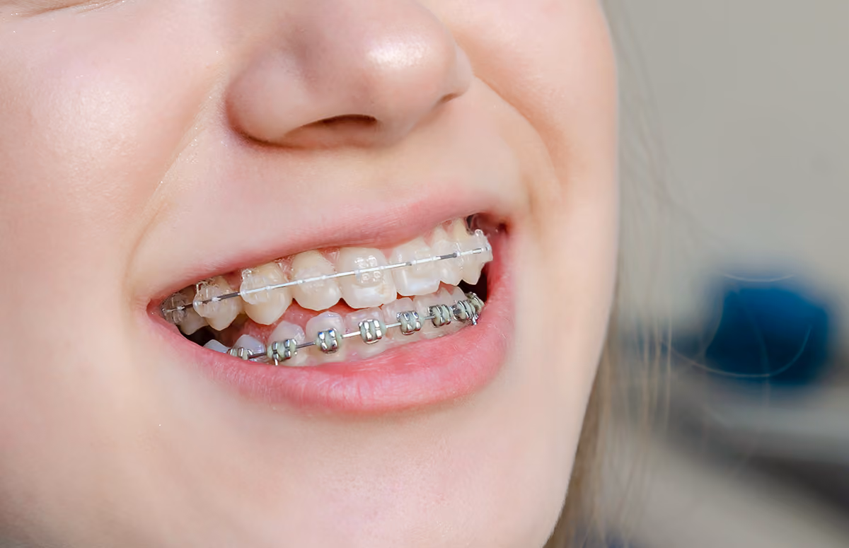 Open Bite Treatment