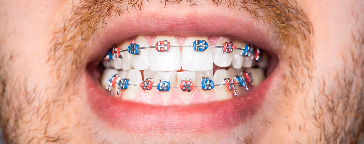 Crossbite Treatment