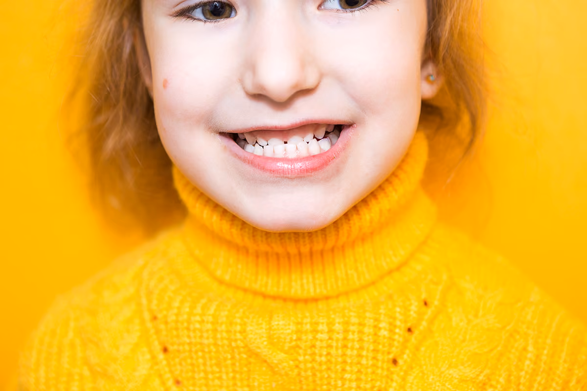 Underbite Treatment