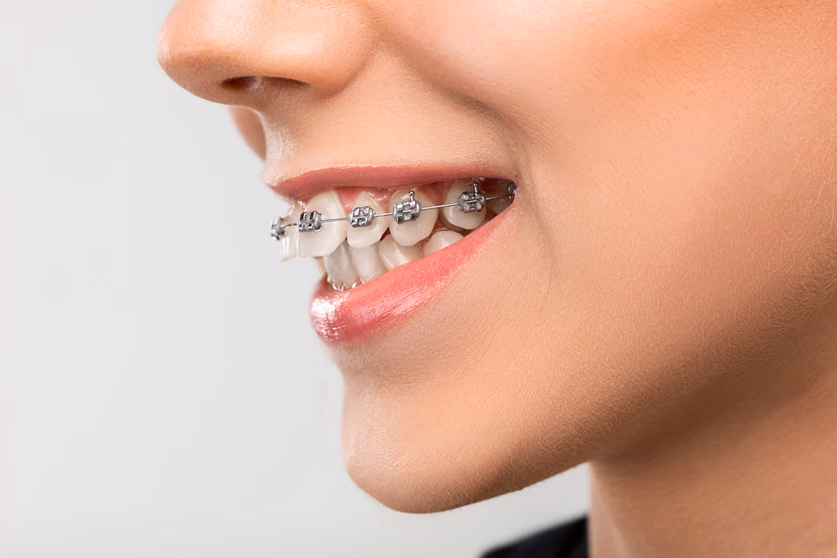 Overbite Treatment