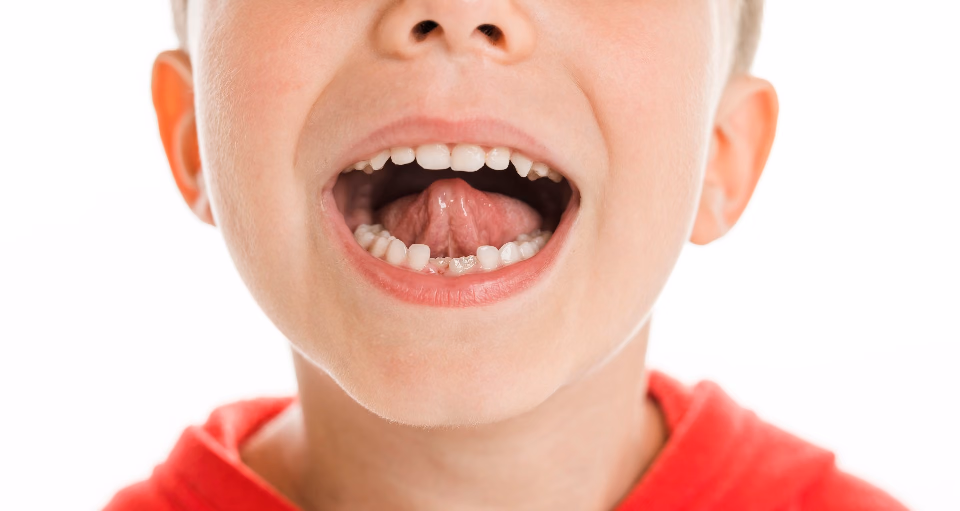 Tongue Thrust Treatment in Lutz