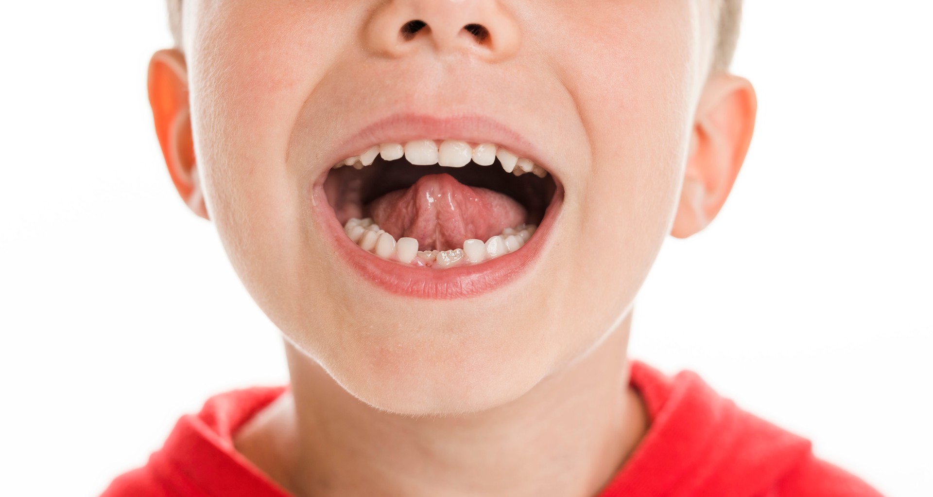 Tongue Thrust Treatment in Lutz | Lightning Orthodontic