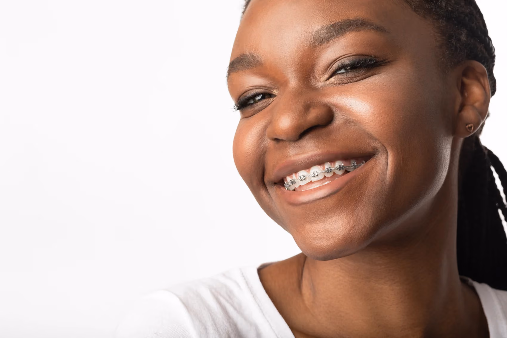 Braces Cost