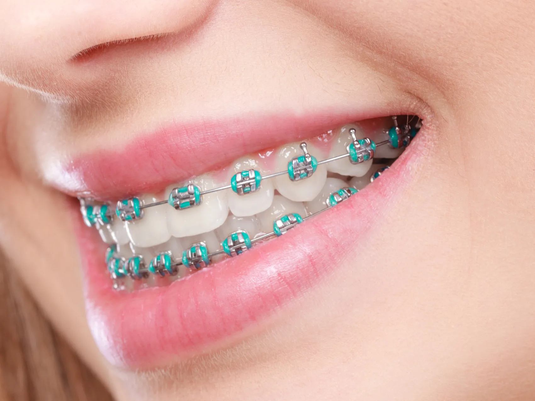 Clear Aligners vs Braces