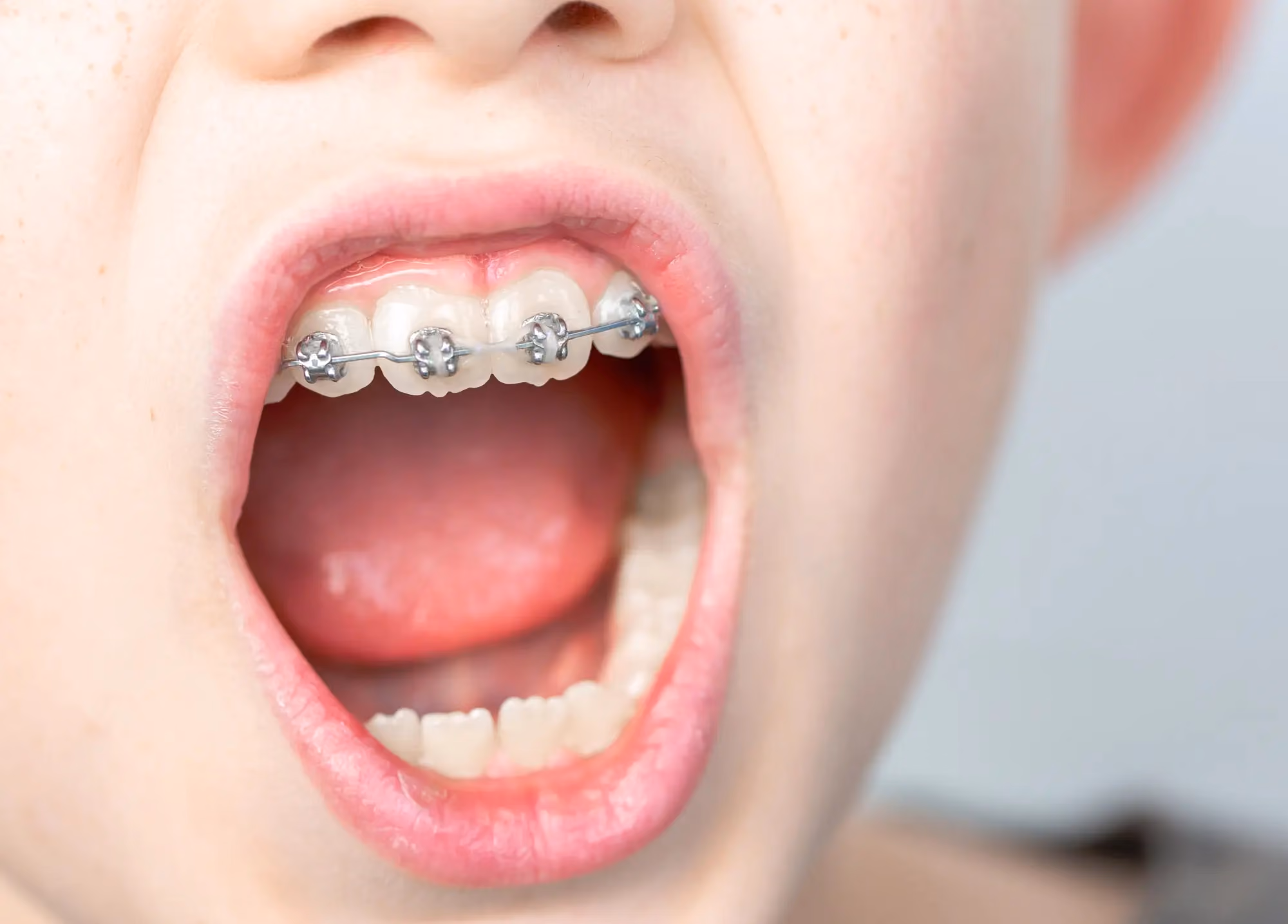Does My Child Need Braces? A Guide for Wesley Chapel Parents