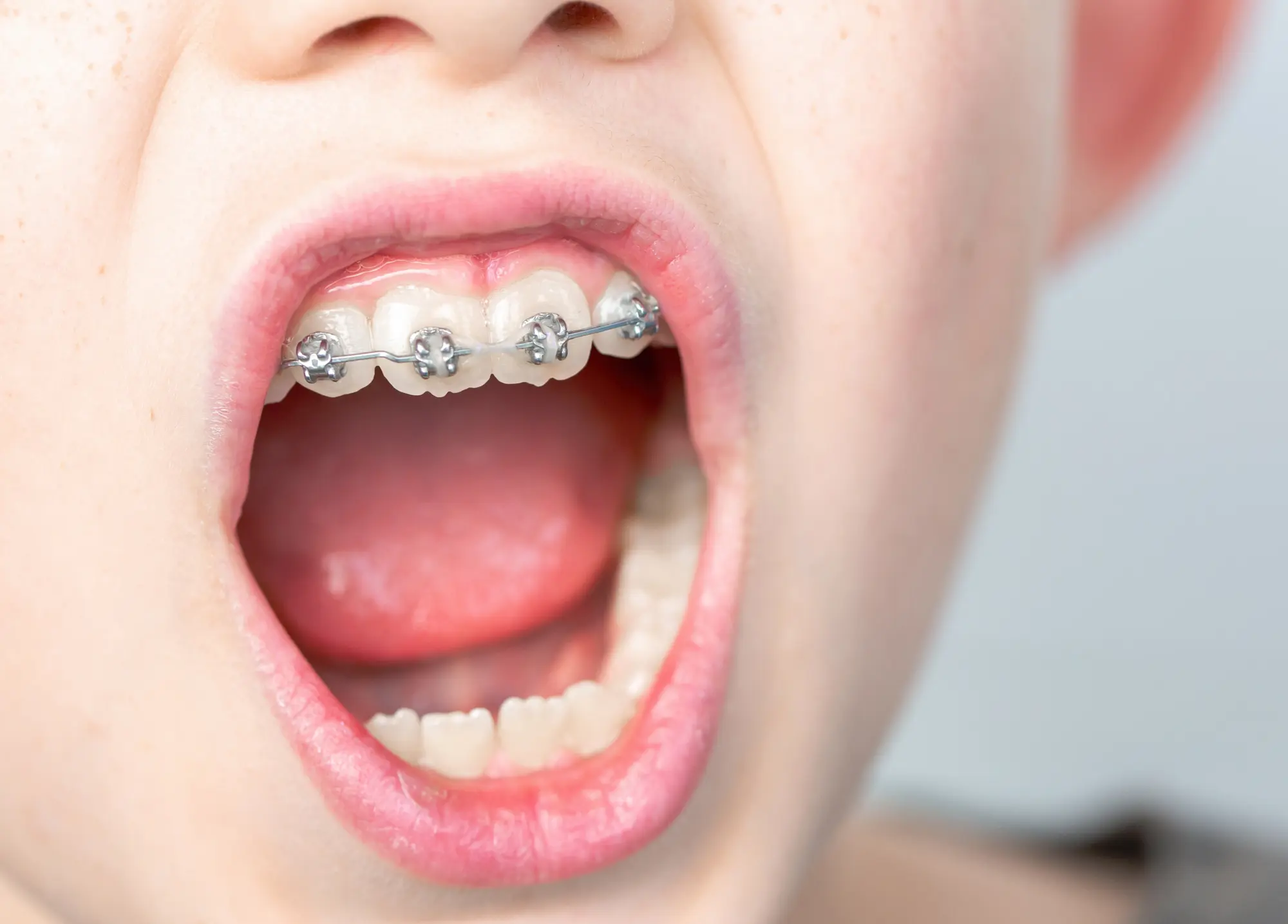 Does My Child Need Braces? A Guide for Wesley Chapel Parents