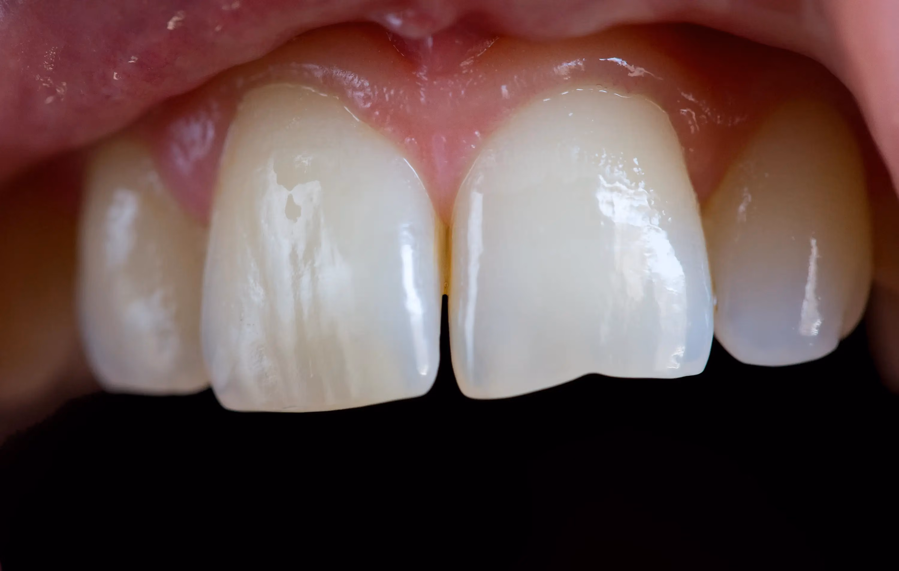 Uneven Tooth Wear in Lutz