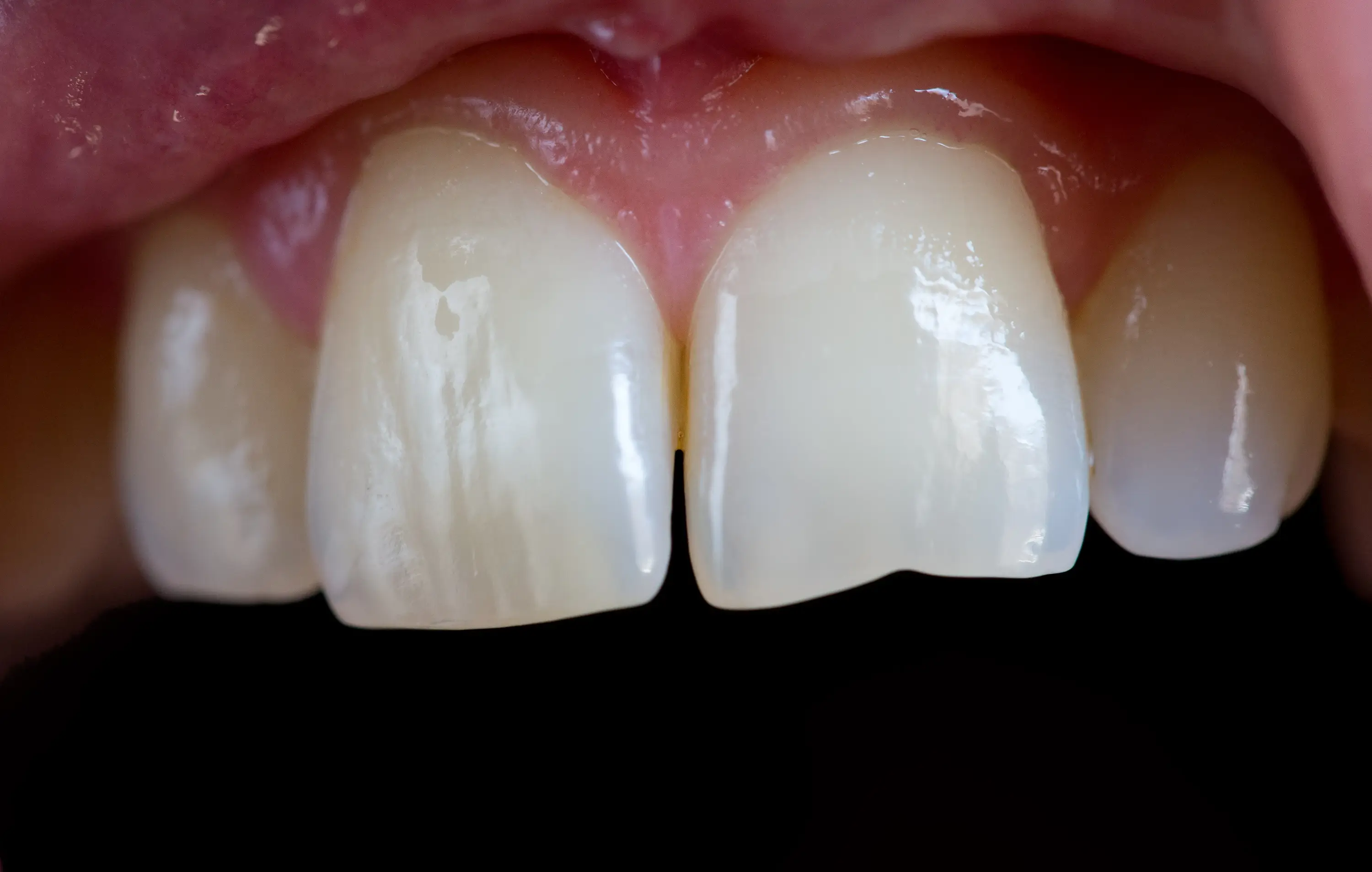 Uneven Tooth Wear in Lutz
