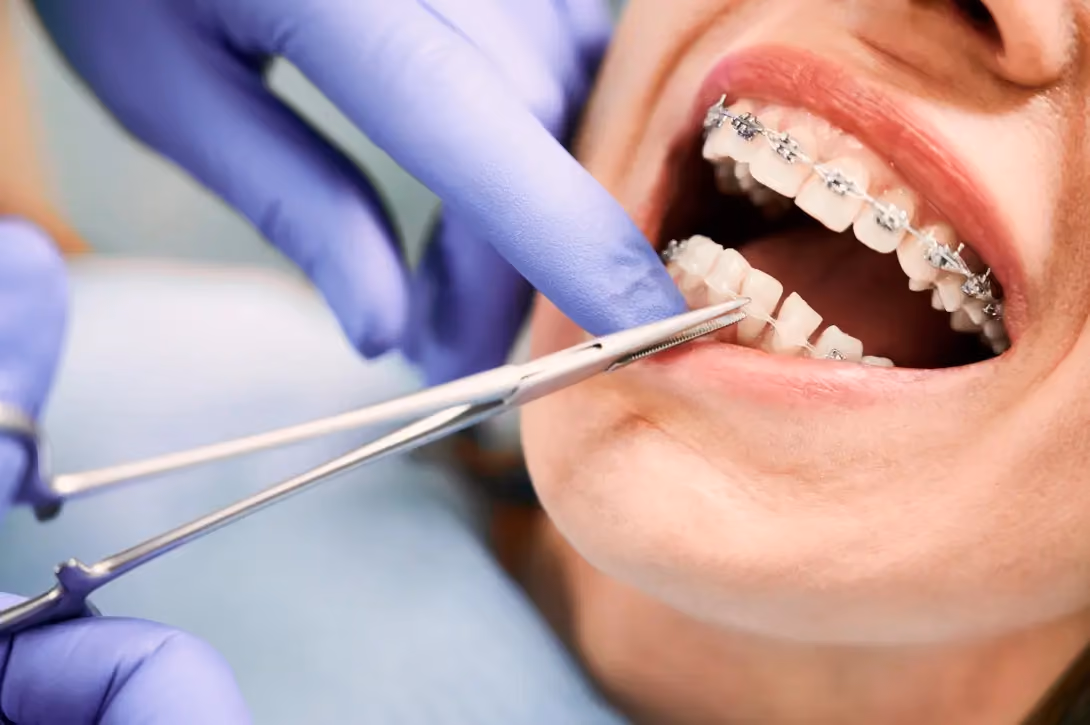 Teen Orthodontics in Lutz