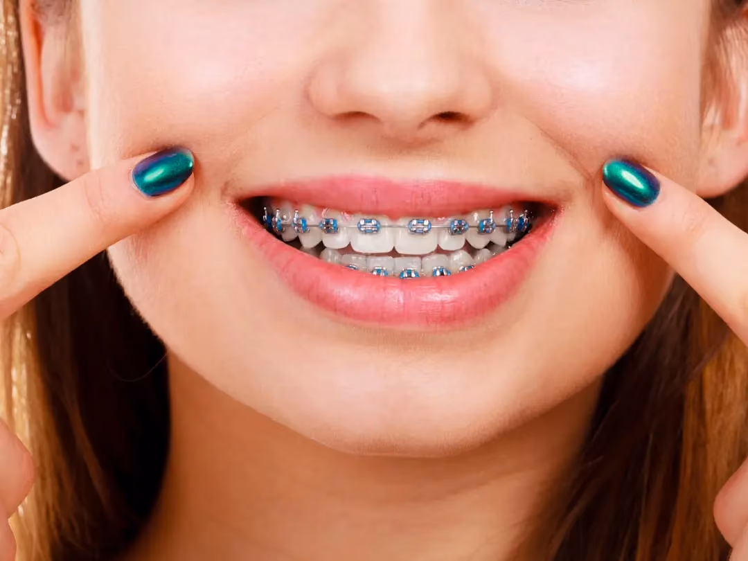 Does Insurance Cover Braces