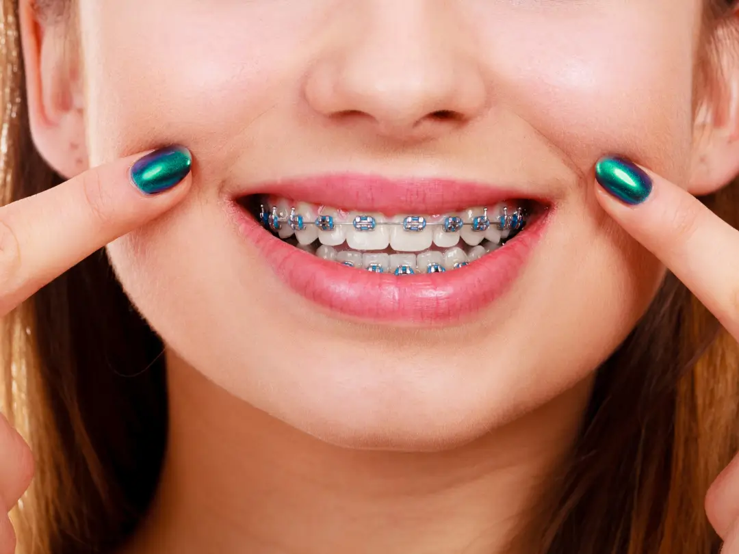 Does Insurance Cover Braces