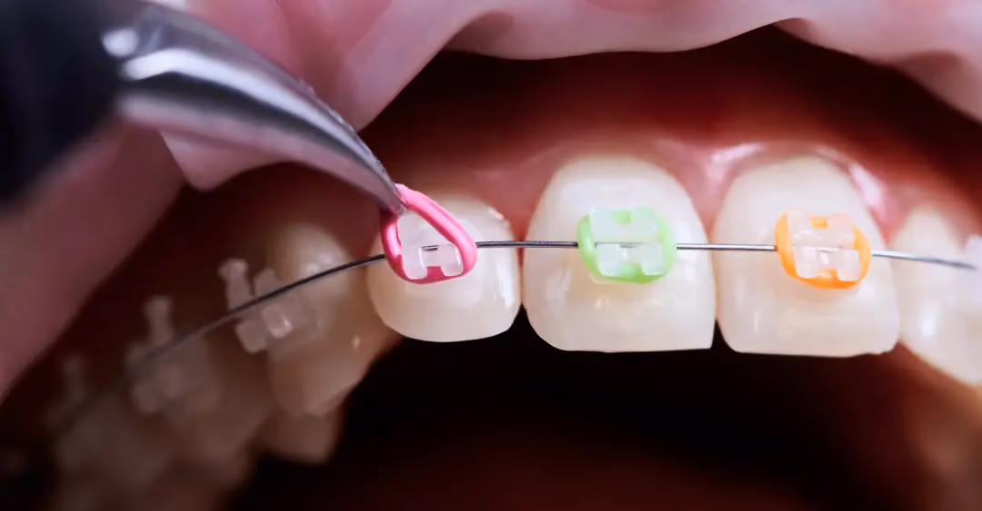 Braces Payment Plans