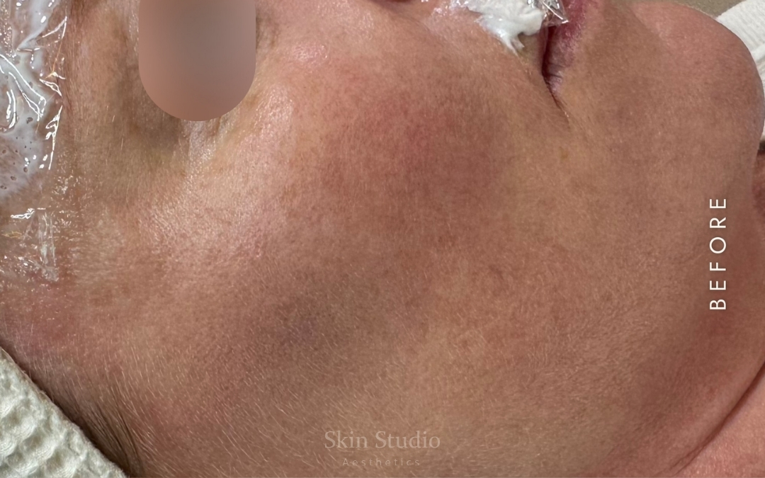 Before and after skin booster treatment for cheeks showing improved skin texture