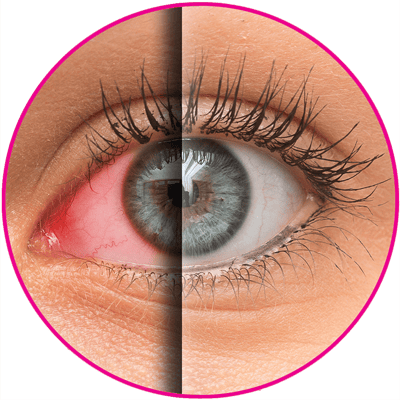 A split image of an eye with dry-eye symtoms and a normal looking eye.