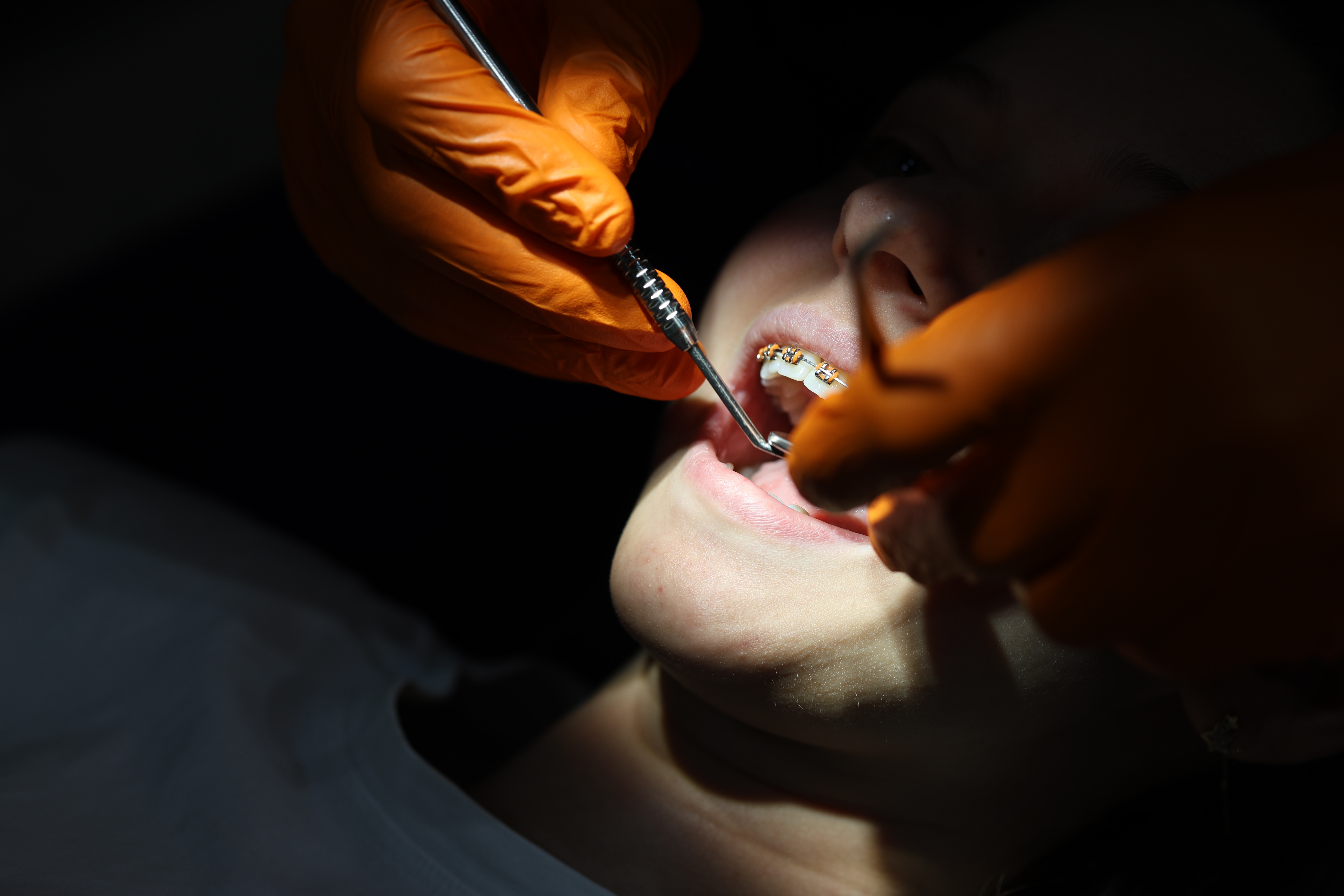 Adevărul sincer despre purtarea aparatului dentar