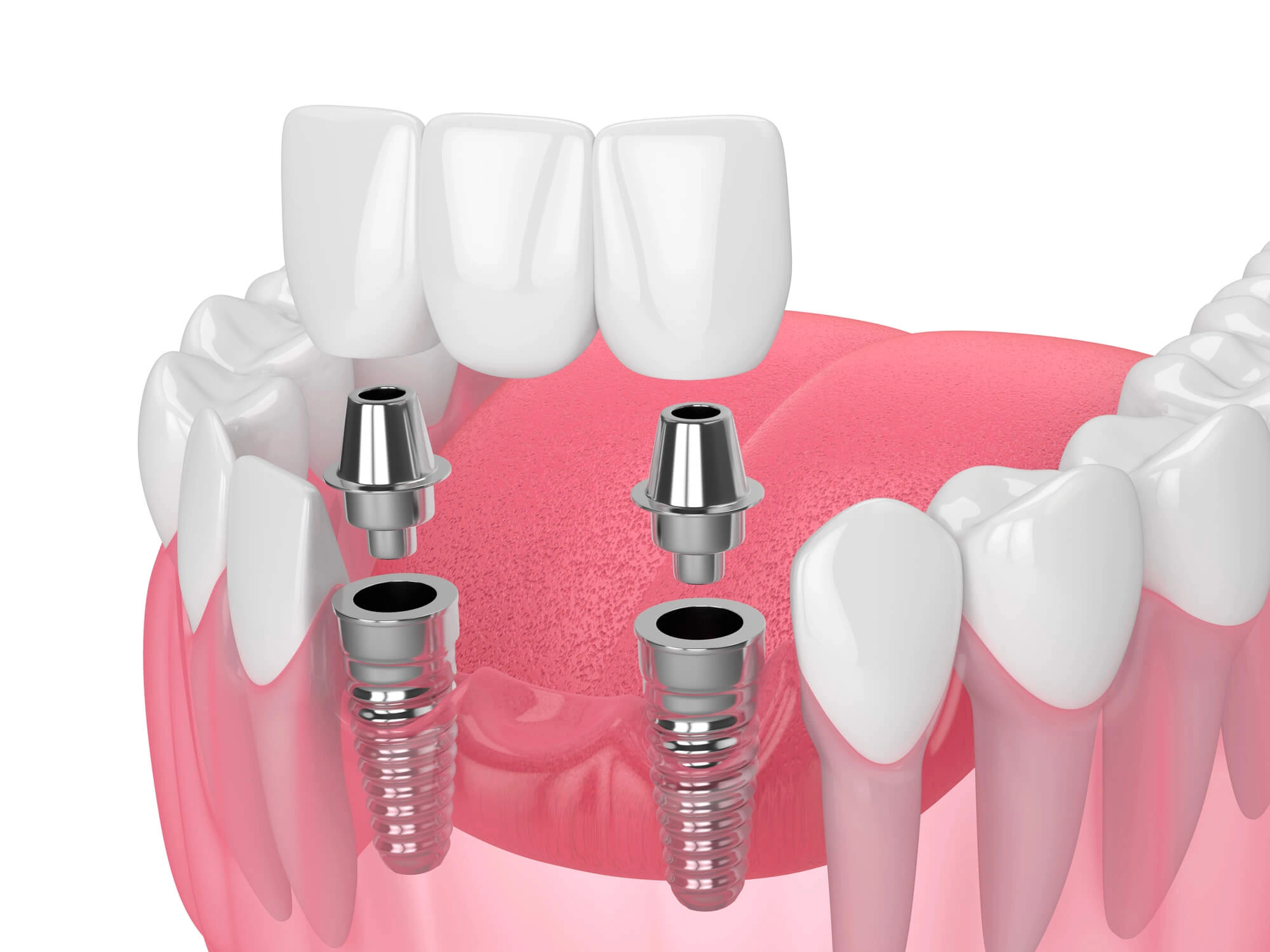 3D illustration of implants by dentist Charlotte NC