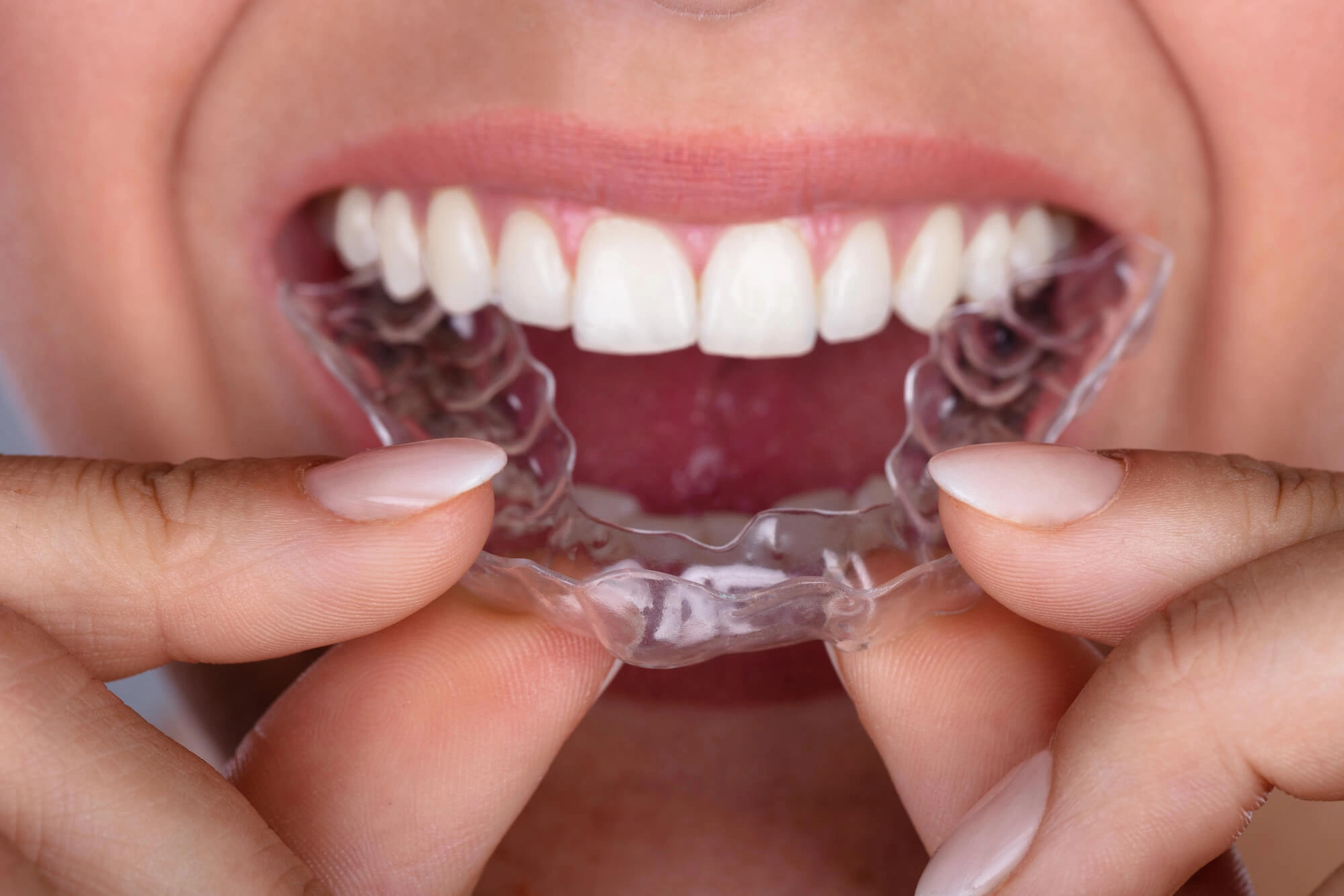 Veneers in cosmetic dentistry in Charlotte 