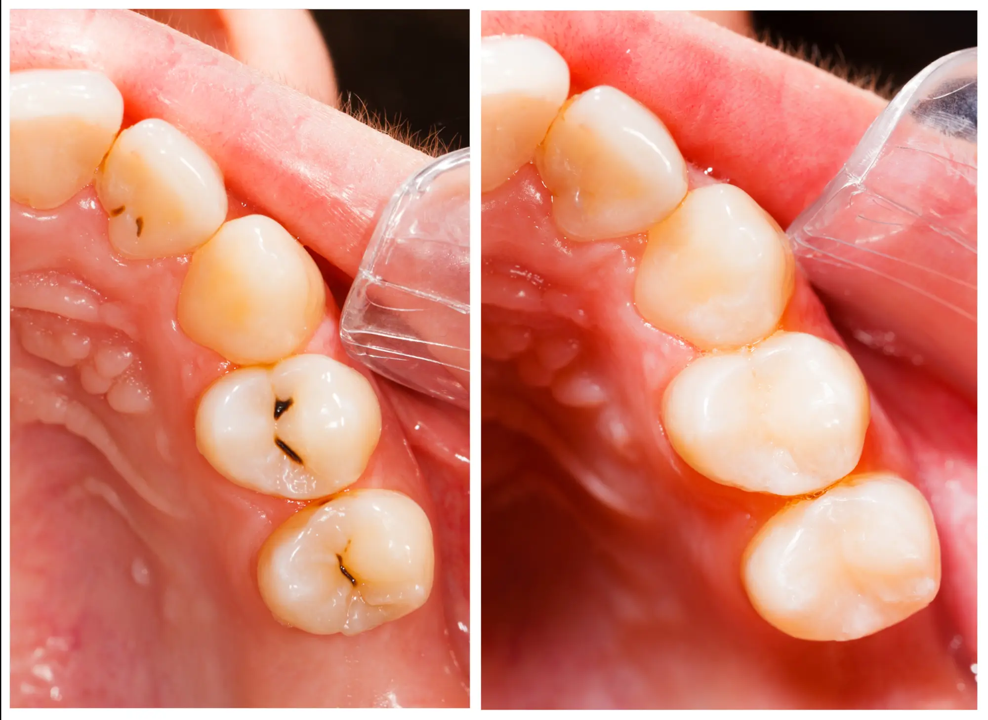 Dental Fillings in San Diego: Seamlessly Repair Cavities with Tooth-Colored Composite