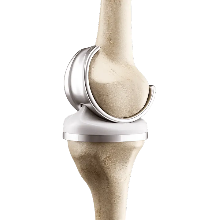 Knee replacement surgery