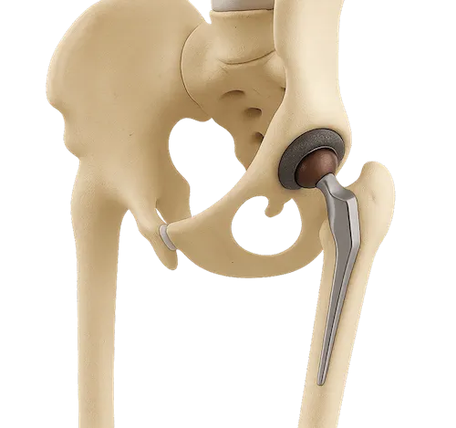 Hip replacement surgery