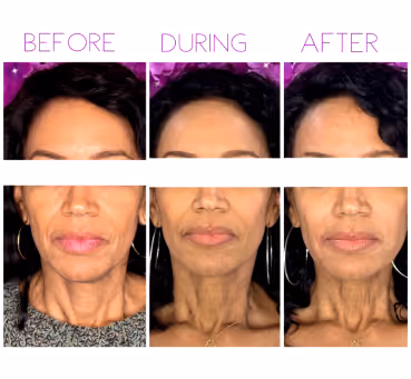 Before during after photo