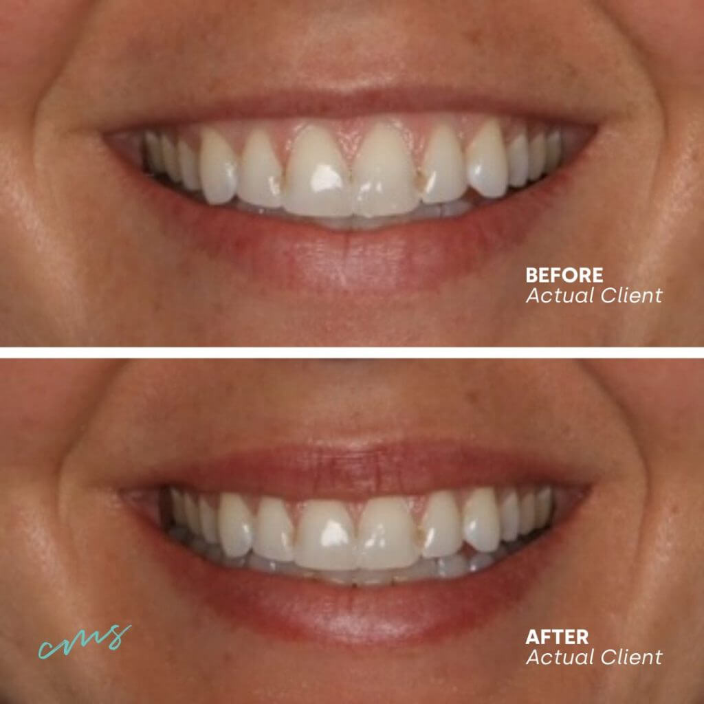 Lip Flip Couture Med Spa