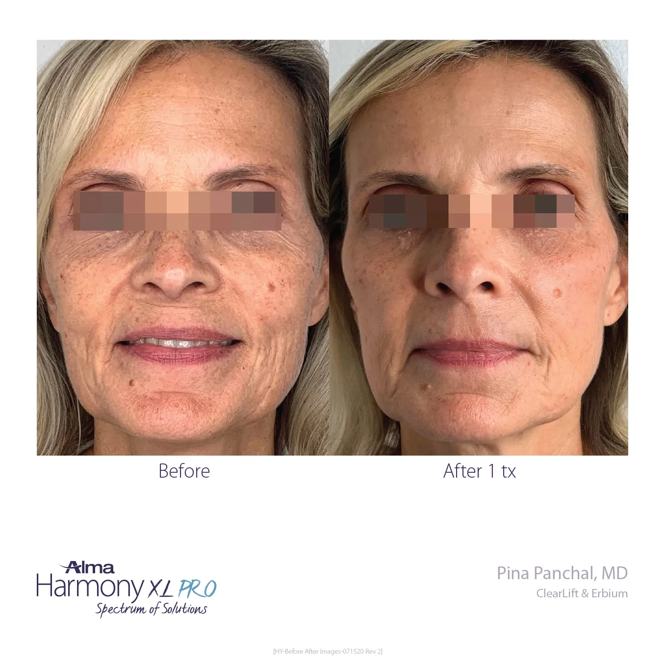 clearlift
