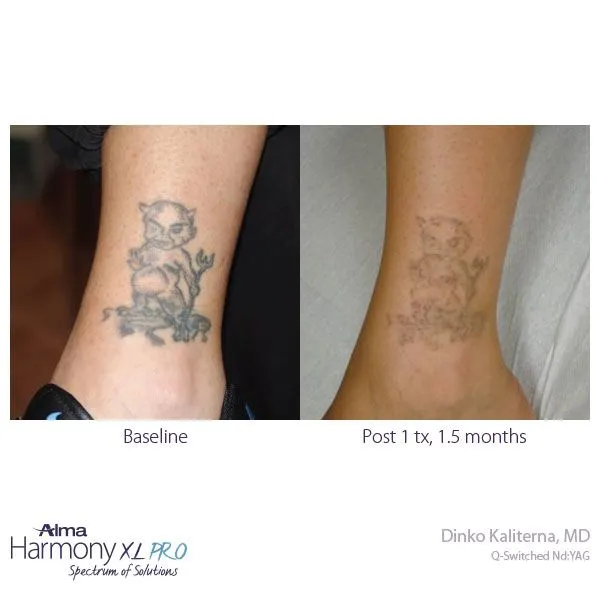 tattoo removal
