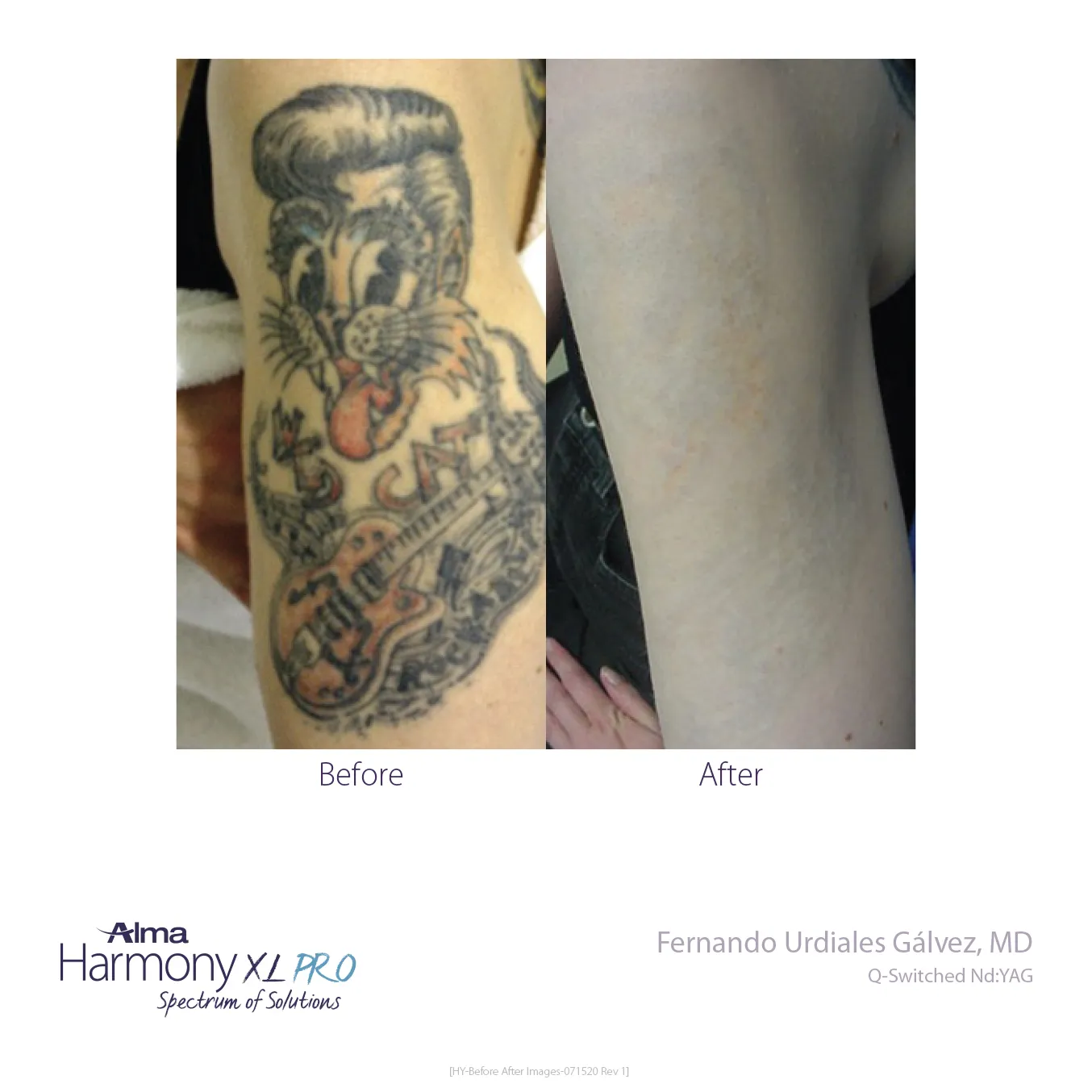 tattoo removal
