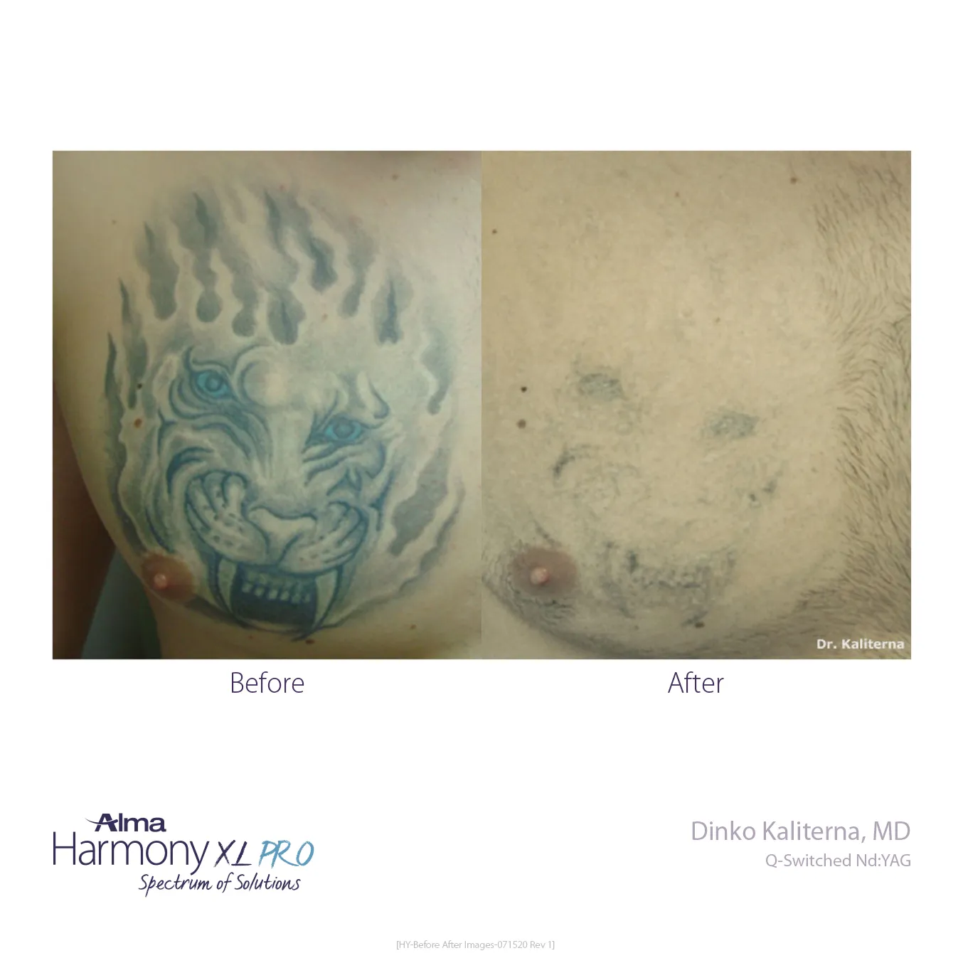 tattoo removal

