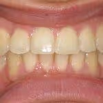 Overbite After HOP Treatment