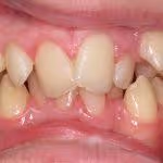Crossbite Before HOP Treatment
