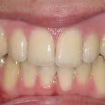 Crossbite After HOP Treatment