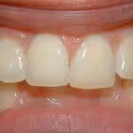 Overbite Before HOP Treatment