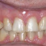 Teeth Spacing Problems After HOP Treatment