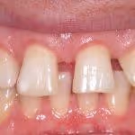 Teeth Spacing Problems Before HOP Treatment