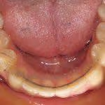 Crowded Teeth After HOP Treatment