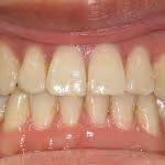 Underbite After HOP Treatment