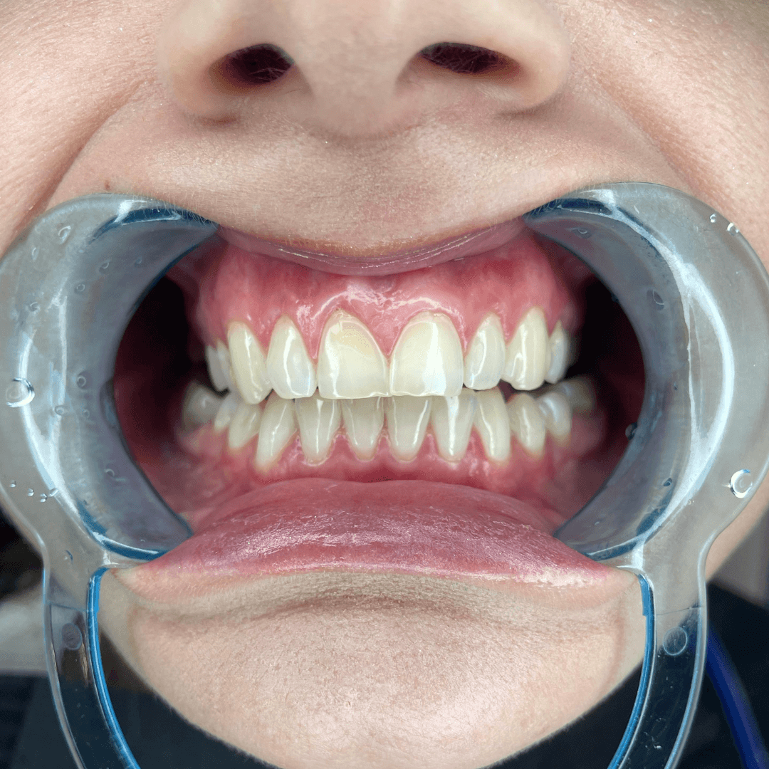 a person with mouth open and mouth with mouth guard
