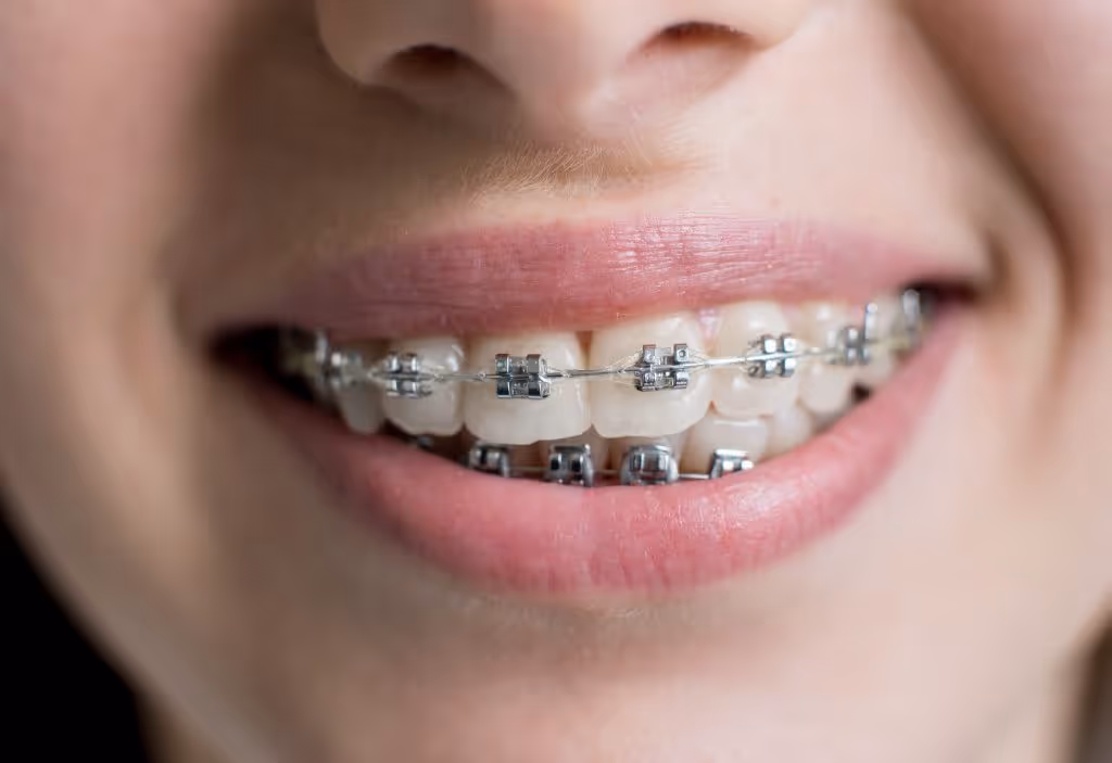 sonrisa de persona que muestra sus brackets autoligados