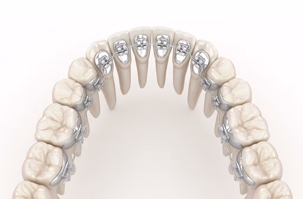 Sistema de brackets linguales