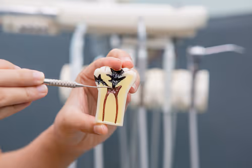 que es endodoncia