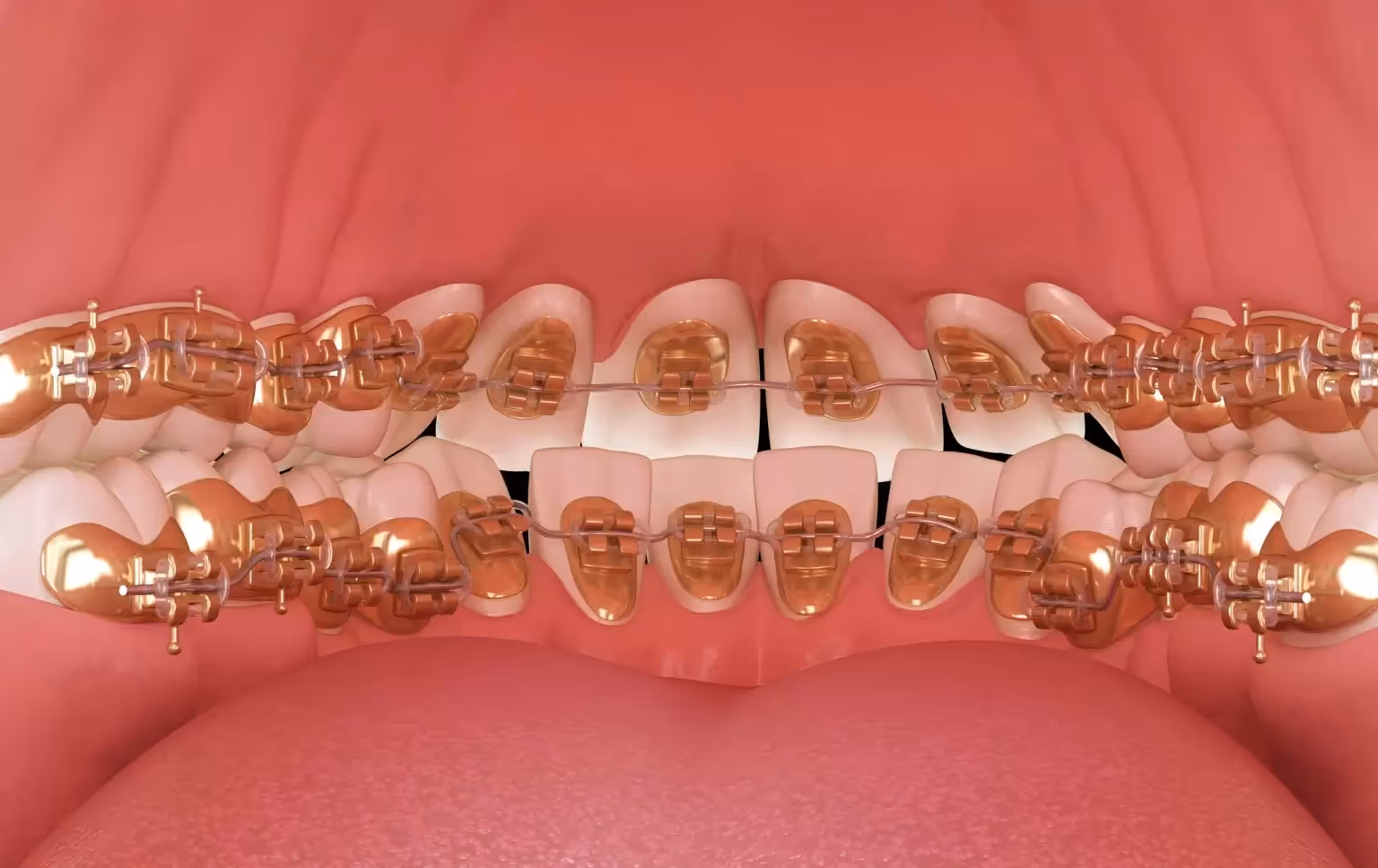 Imagen de dientes con brackets linguales