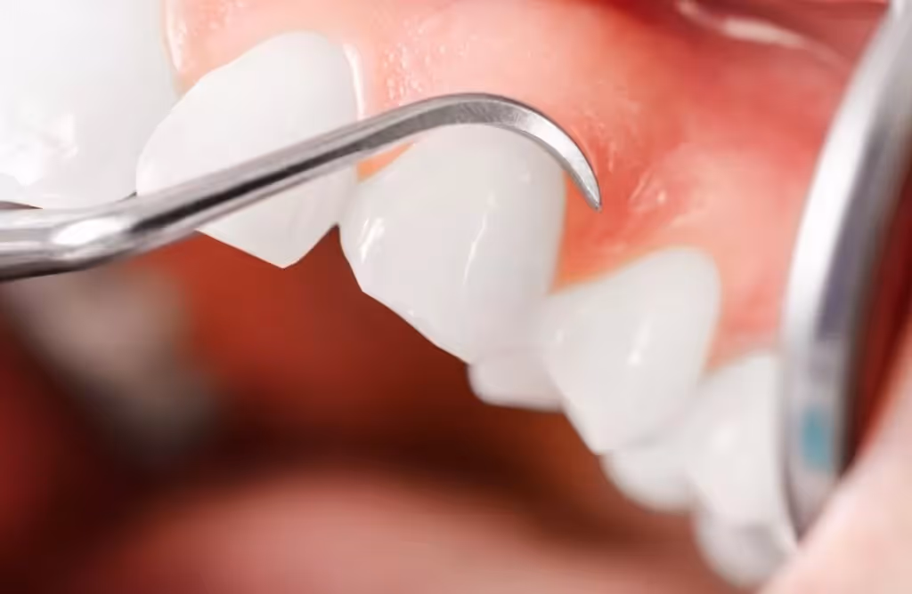Antes y después de una limpieza dental para remover placas