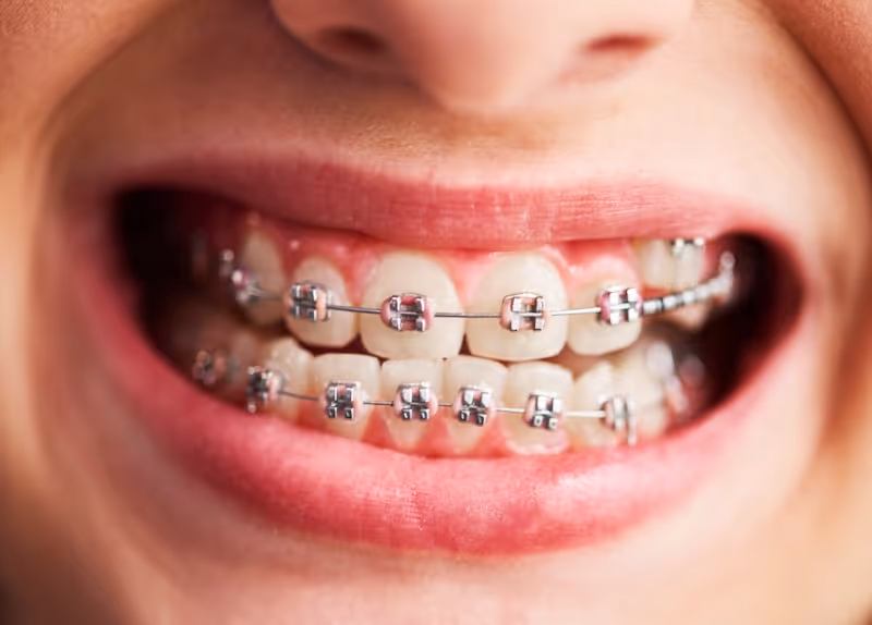 Paciente sonriendo con tratamiento de ortodoncia