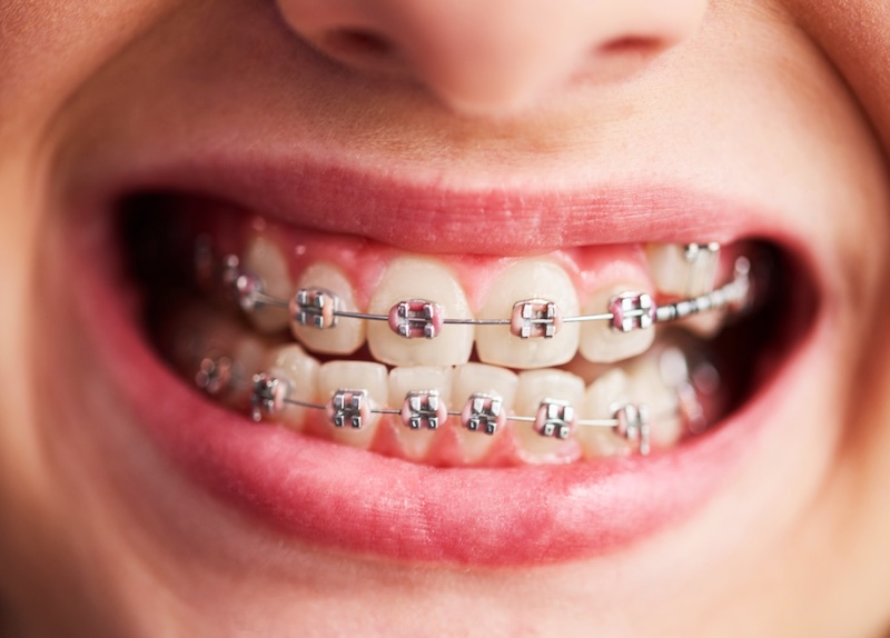 Paciente sonriendo con tratamiento de ortodoncia