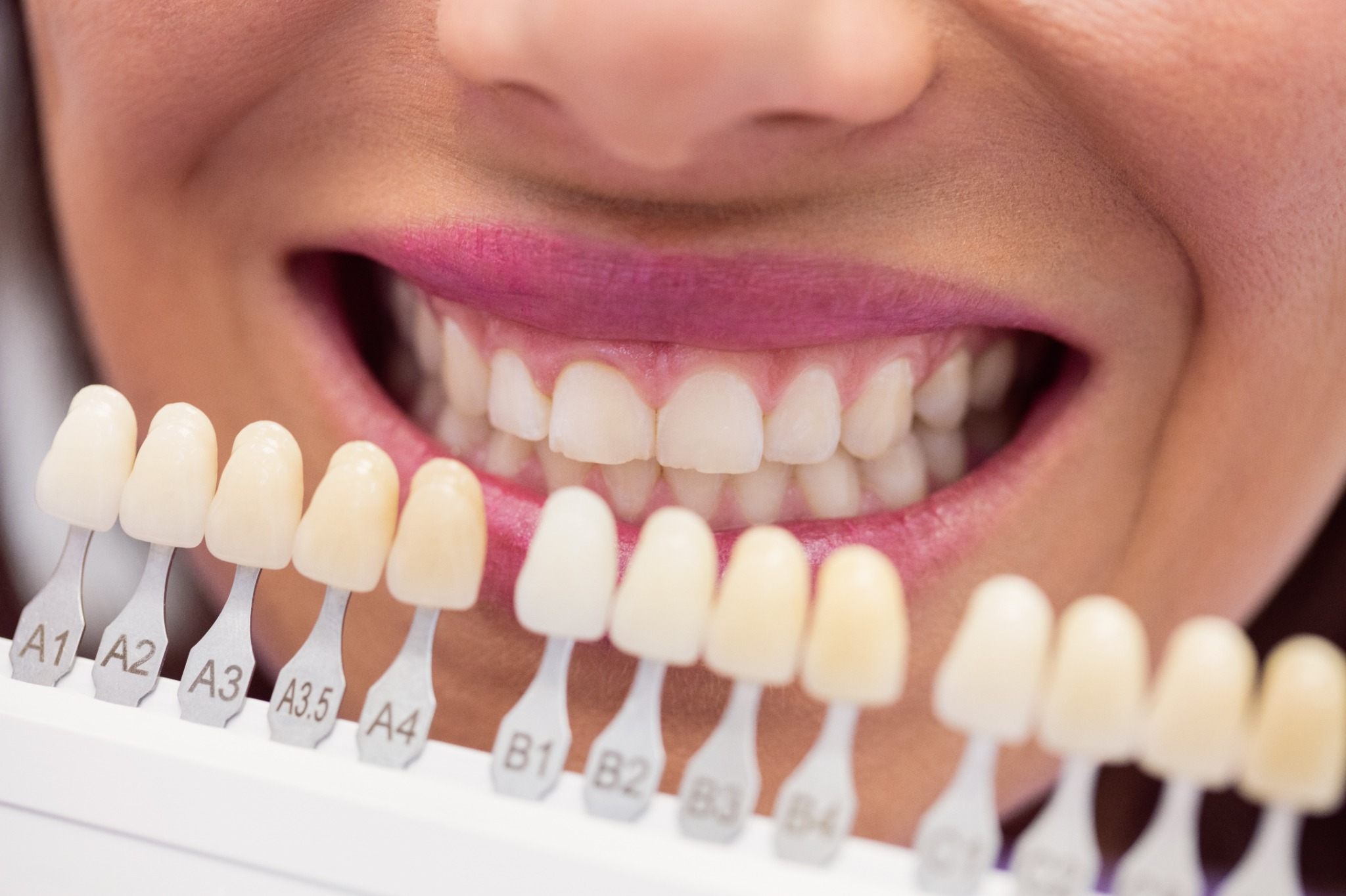 duele colocar carillas dentales
