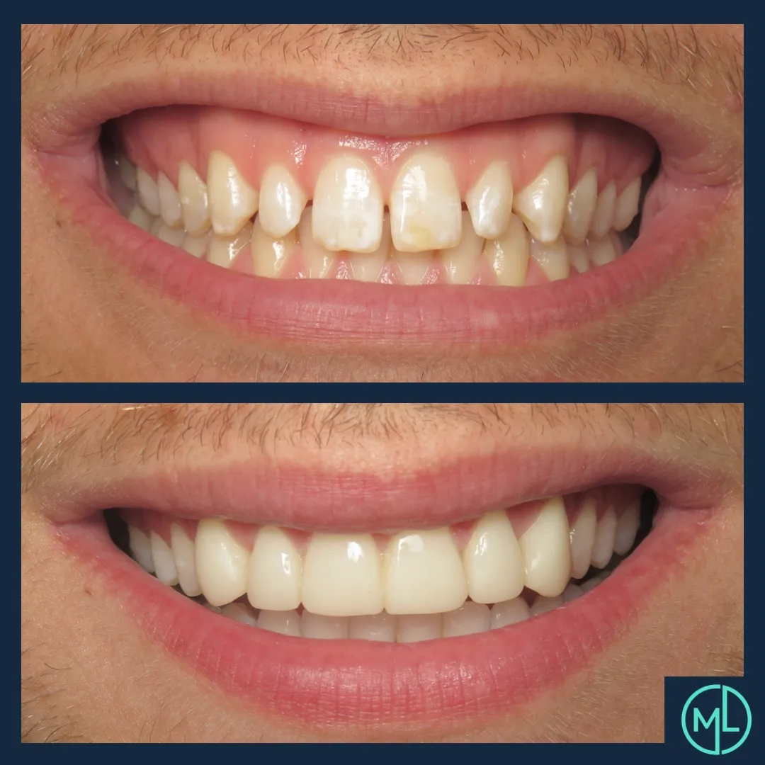 Before after image